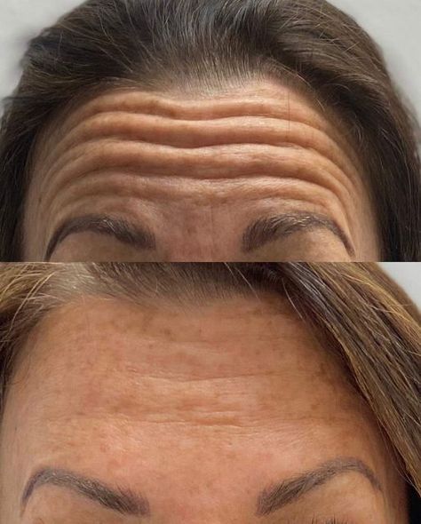 Blu Salon + Spa Watertown on Instagram: "Before and after Botulinum Toxins (sometimes referred to as Botox) with Katie!😍" Botulinum Toxin, Lower Back Pain Exercises, Preventative Health, Back Pain Exercises, Med Spa, Lower Back, Back Pain, Belly Fat, Spa