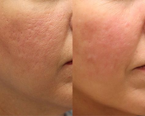 Microneedling Before And After, Microneedling Aesthetic, Laser & Ipl Hair Removal Devices, Skin Care Pictures, Acne Scarring, Beauty Video Ideas, Facial Aesthetics, Eye Liner Tricks, Ipl Hair Removal