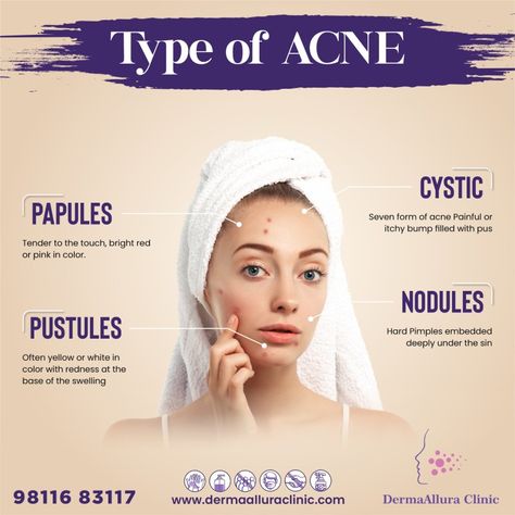 Hair Poster Design, Best Acne Cleanser, Cosmetics Ads, Hair Poster, Acne Cleanser, Beauty Poster, Acne Soap, Acne Toner, Pimples On Face