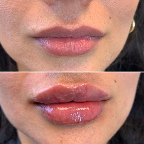 Lip Filler Russian, Russian Lips Filler Before And After, 1 Syringe Lip Filler, Russian Lips Filler, Dream Lips, Russian Lips, Lips Inspiration, Skin Care Pictures, Cheek Fillers