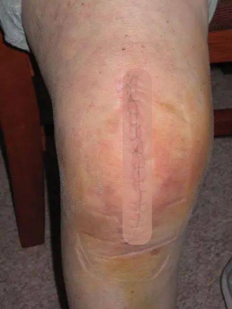 Sleeping After Knee Replacement, Bone On Bone Knee Pain Relief, How To Tape Knee For Pain, Knee Replacement Recovery Tips, Knee Cartilage Repair, Nerves In Leg, Full Knee Replacement, Knee Replacement Pain, Physio Tips