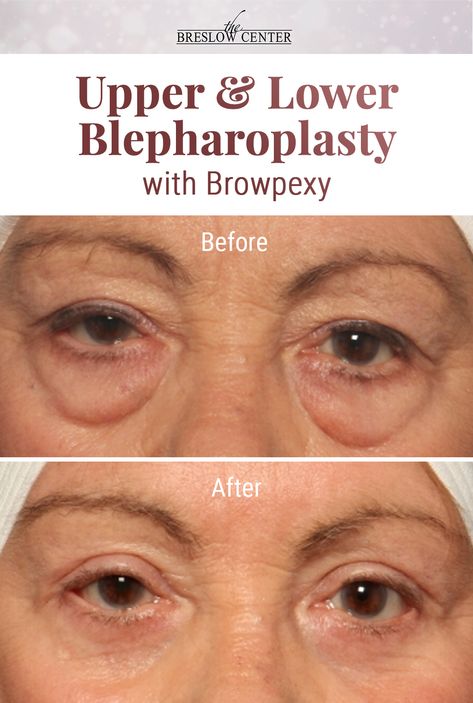 Procedure: Upper and lower blepharoplasty, browpexy: patient wanted to get rid of the bags under her eyes and appear more rested. Surgeon: Gary D. Breslow, MD. Browse through the many before and after pictures of procedures we've performed. Belfaroplasty Eyes, Under Eye Surgery Before And After, Fibroblast Before And After Eyes, Eye Surgery Before And After, Eye Lid Surgery Before And After, Lower Blephoraplasty Before And After, Undereye Filler Before And After, Botox Under Eyes Before And After, Under Eye Filler Before And After