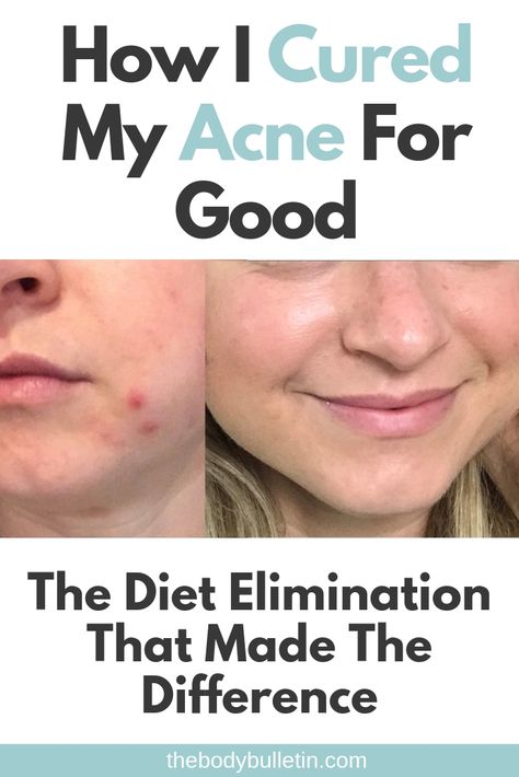 I've been plagued with acne my entire life Dairy was a staple in my diet, I gave it up for clear skin but forgot one thing that made all the difference... Clear Skin Remedies, Clear Skin Detox, Combination Skin Face Wash, Clear Skin Diet, Acne Diet, Skin Diet, Clear Skin Face, Acne Causes, Clear Skin Tips