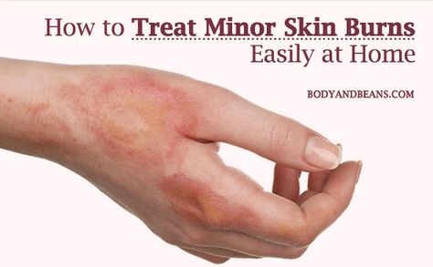 Wondering about how to treat minor skin burns at home? Here’s the list of 14 home remedies that will help you in treating minor skin burns easily. Fire Burns On Skin, Burn Scar Remedies, Burn Relief Skin, Burned Skin Remedies, Home Remedies For Burns, 2nd Degree Burns, Burn Ointment, Burn Remedy, Scar Remedies