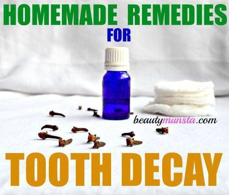 Reverse Tooth Decay, Tooth Extraction Aftercare, Tooth Extraction Healing, Baby Tooth Decay, Tooth Ache Relief, Sensitive Teeth Remedy, Tooth Decay Remedies, Remedies For Tooth Ache, Teeth Whitening Homemade