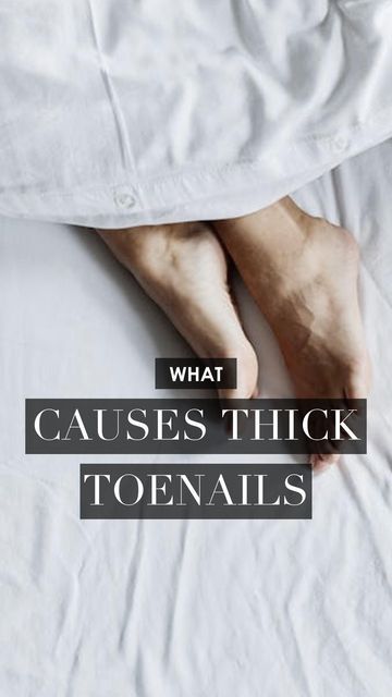 Madame Sweat on Instagram: "#watchnow what might be the cause of your thick #toenails! #toenailfungus" Toenail Fungus, Pedicures, Fitness And Health, Mani Pedi, Healthy Body, Manicure And Pedicure, Toe Nails, Manicure, Health