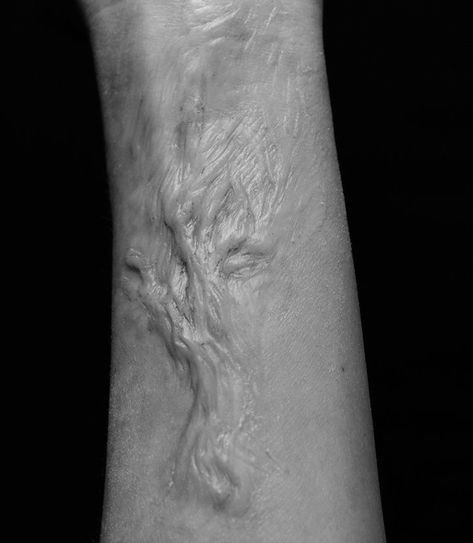 Healed Burn Scar Reference Drawing, Burned Skin Aesthetic, Track Marks On Arm, Infected Aesthetic, Burn Scar Reference Drawing, Scar Aesthetic, Face Burn, Burnt Face, Burn Wound