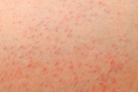 Red Dots On Legs Skin, Red Rashes On Skin, Skin Rashes Pictures Types Of, Skin Rashes Pictures, Rash On Back, Allergic Reaction Rash, Leg Rash, Types Of Skin Rashes, Rash On Face