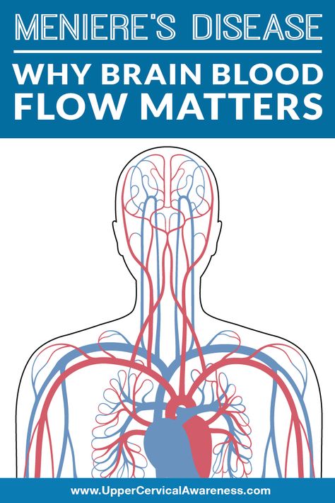 Many patients with Meniere’s disease have excess fluid in their ear, but not all can have this. Therefore, there must be other factors involved with Meniere’s. You have a higher chance of getting Meniere’s if you have any of the following factors. #VertigoRelief #DizzinessRelief #VertigoSufferer #VertigoTips #NaturalRelief Ménière’s Disease, Meneires Disease, Fluid In Ears, Upper Cervical Chiropractic, Vertigo Symptoms, Vertigo Relief, Loss Of Balance, Neck Injury, Degenerative Disease