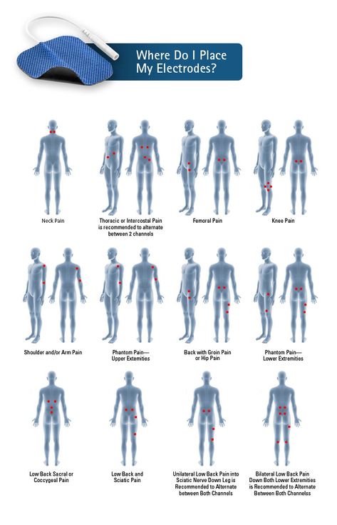 Tens Placement, Tens Electrode Placement, Tens Unit Placement, Tens And Units, Tens Machine, Shoulder Tension, Tens Unit, Tens Ems, Ten Unit