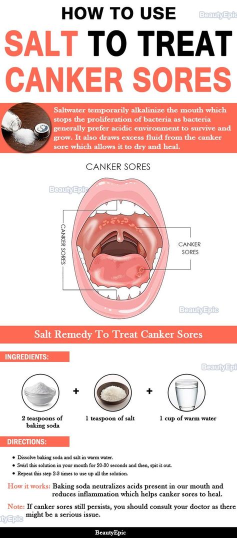 how to use salt to treat canker sores Canker Sore Remedy, Healthy Gums, Canker Sore, Stronger Teeth, Oral Care Routine, Gum Care, Receding Gums, Cold Sore, Oral Health Care