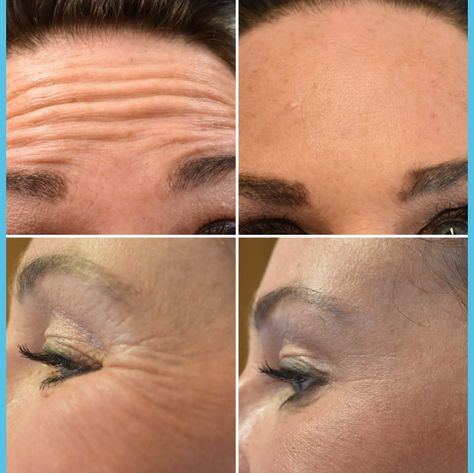 Anti-wrinkle treatments at forever  young aesthetics call 07828293599 for your free consultation Sculptra Before And After, Botox Anatomy, Botox Wrinkles, Botox Facial, Botox Cosmetic, Cheek Fillers, Belly Dancing Videos, Instagram Branding Design, Skin Care Business