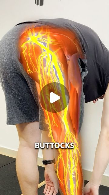 Chronic Back Pain & Sciatica | Online Rehabilitation on Instagram: "⚡️What Is Sciatica?⚡️

Your sciatic nerve runs from your lower back, through your glutes, and all the way down to your feet. When it gets compressed or becomes sensitive, it can cause pain, numbness, or tingling from your buttocks down to your legs.

Here’s how you can reduce nerve compression and desensitize your sciatic nerve in three simple steps:

1️⃣ Bird-Dog Exercise: Strengthen your core and relieve pressure on your sciatic nerve. 

2️⃣ Pelvic Tilts: Improve spinal mobility and reduce nerve compression. 

3️⃣ Clamshells: Strengthen your hips and low back, reducing sciatic nerve irritation.

These movements will help alleviate the pain and discomfort caused by sciatic nerve compression.

If you’re looking for a long- Spinal Mobility, Sciatic Nerve Exercises, Nerve Pain Remedies, Nerve Problems, Chronic Back Pain, Nerve Health, Pelvic Tilt, Strengthen Your Core, Bird Dog