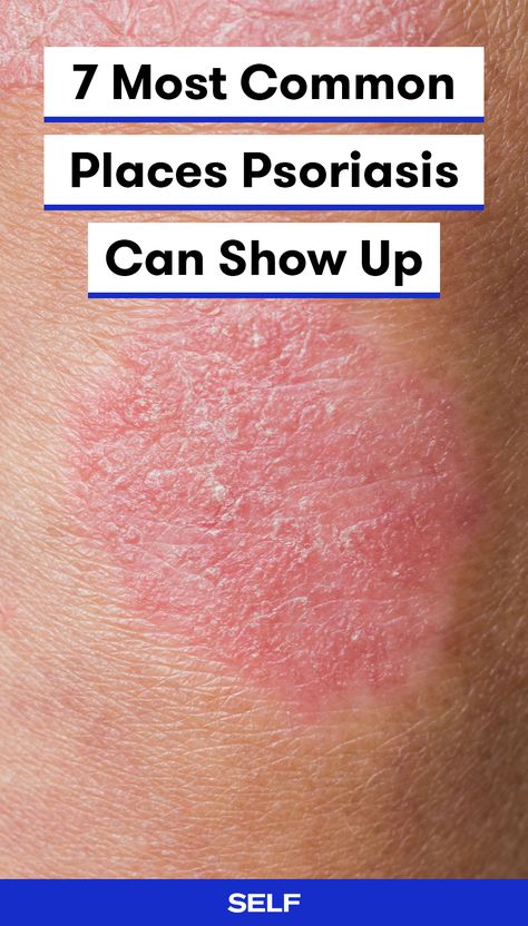 Skin Disease Pictures, Home Remedies For Face, How To Become Healthy, Become Healthy, Skin Disorders, Skin Remedies, Skin Diseases, Dead Sea, Autoimmune Disease