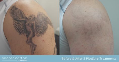 PicoSure Tattoo Removal Case Study & Interview #5 – Andy F https://www.andreacatton.co.uk/2018/01/video-picosure-tattoo-removal-case-study-interview-5-andy-f/ Picosure Tattoo Removal, Skin Laser, Laser Skin, Tattoo Removal, After Photos, Case Study, How Many, Interview, Tattoos