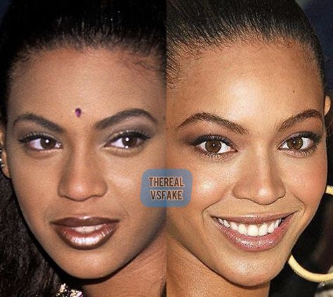 Beyonce Nose Job, Ethnic Rhinoplasty, Nose Plastic Surgery, Nose Fillers, Kpop Plastic Surgery, Jaw Reduction Surgery, Celebrity Surgery, Face Fillers, Plastic Surgery Fail