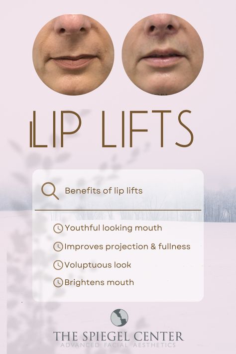 We perform lip lifts under local anesthesia right in office! Takes about 45 min and you can drive your self home! Click here to watch our video to learn more! Local Anesthesia, Lip Lift, Facial Aesthetics, 20 Years, Facial, Lips, Drive