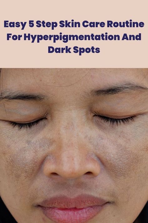 Treating hyperpigmentation became this easy with these 5 skin care steps. Here's how!
#pigmentation #darkspot #skincareroutine #unevenskintone Dark Patches On Face, Face Hyperpigmentation, Skin Care Hyperpigmentation, Acne Overnight, Treating Hyperpigmentation, Oily Skin Acne, Face Routine, Dark Spots On Face, Brown Spots On Face