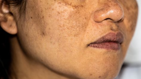 Here's How To Treat Hyperpigmentation Once And For All Body Hyperpigmentation, Treat Hyperpigmentation, Age Spot Removal, Treating Hyperpigmentation, Natural Skin Care Remedies, Best Serum, Chemical Peel, Skin Care Remedies, Hair Transplant