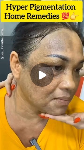 Pigmentation Remedy, Diy Facial Mask, Skin Care Home Remedies, Acne Free Skin, Dry Skin Body, Basic Workout, Dark Spots On Skin, Perfect Skin Care Routine, Viral Reels