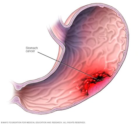 Types Of Cancers, Mayo Clinic, Natural Treatments, Disease