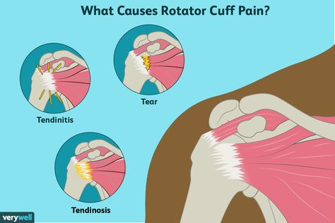 rotator cuff pain causes Torn Rotator Cuff Symptoms, Anatomy Spine, Shoulder Muscle Pain, Rotator Cuff Pain, Shoulder Rehab Exercises, Exercise Therapy, Rehab Exercises, Shoulder Rehab, Human Biology