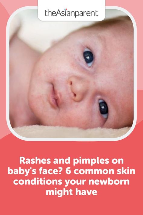 Nappy Rash Remedies Natural, Newborn Skin Peeling, Newborn Rash, Baby Heat Rash, Skin To Skin Benefits Baby, Redness Pimple, Baby Dry Skin, Red Rash, Baby Acne