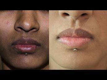 How To Remove Dark Spots, Black Patches, Hyper pigmentation _ Around Mouth | SuperWowStyle Prachi - YouTube Dark Patches On Face, Skin Care In Summer, Dark Skin Around Mouth, Darkness Around Mouth, Black Spots On Face, Scar Revision, Removing Hyperpigmentation, Eyeshadow For Beginners, How To Do Eyeshadow