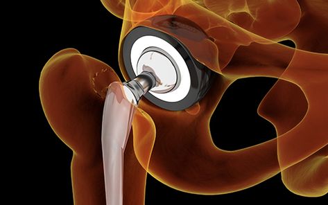 Stop arthritic hip pain from debilitating you. Uncover how total hip replacement surgery can restore your mobility and dignity. #HipReplacement #Arthritis #ReflexologyAthensGa Total Hip Surgery, Hip Operation, Hip Surgery Recovery, Morning Yoga Stretches, Hip Brace, Hip Surgery, Hip Mobility, Surgery Recovery, Cartoon Pictures