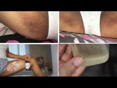 I hope you all have enjoyed this video on how to properly remove inner thigh dark spots / dark spots between your thighs.For Hyperpigmentation on the face wa... Dark Spots Under Armpits, Dark Spots Under Eyes, Dark Spots On Legs, Dark Spots Remedies, Exfoliating Lip Scrub, Dark Spots On Face, Face Scrub Homemade, Dark Spots On Skin, Proper Skin Care