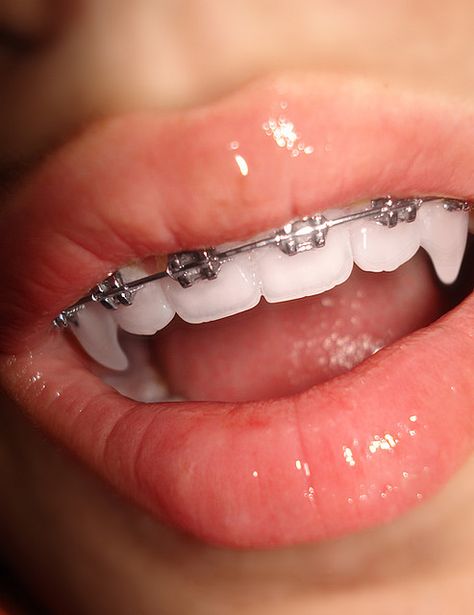 Like a.....vampire... Cute Braces Colors, Teeth Aesthetic, Braces Girls, Cute Braces, Brace Face, Braces Colors, Teeth Braces, Vampire Fangs, Vampire Teeth