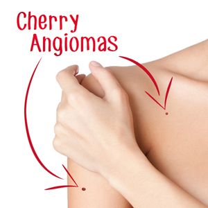 Cherry Angioma Removal, Red Skin Spots, Mole Meaning, Red Freckles, Red Moles, Remove Skin Tags Naturally, Skin Moles, Skin Spots, Red Dots