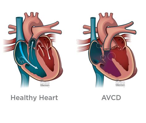 Atrioventricular canal defect (AVCD), also known as atrioventricular septal defect (AVSD) or AV Canal, is a heart defect in the part of the heart that connects the atria to the ventricles. Learn how we treat this condition at SSM Health Cardinal Glennon St. Louis Fetal Care Institute. Cardiothoracic Surgery, Tricuspid Valve, Parts Of The Heart, Open Heart Surgery, Congenital Heart Defect, Heart Defect, Congenital Heart, Heart Conditions, Heart Surgery