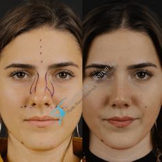 Bulbous Nose Rhinoplasty Before After, Wide Nose Rhinoplasty, Ethnic Nose Job, Bulbous Nose Rhinoplasty, Nose Plastic Surgery, Nose Surgery Rhinoplasty, Bulbous Nose, Rhinoplasty Nose Jobs, Rhinoplasty Before And After