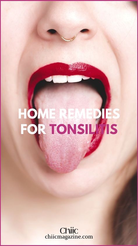 Easy Ways to Cure Tonsillitis Throat Infection Remedy, Throat Infection, Glam Wedding Makeup, Viral Infection, Health Advice, Natural Treatments, Health Lifestyle, Home Remedies, Natural Remedies