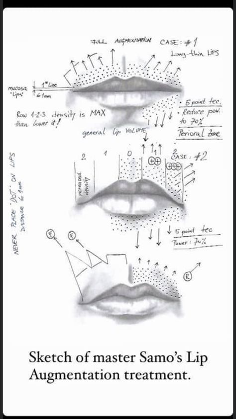 Plasma Pen, Botox For Headaches, Plasma Facial, Face Injections, Skin Tightening Procedures, Skin Anatomy, Skin Tightening Treatments, Botox Lips, Permanente Make-up