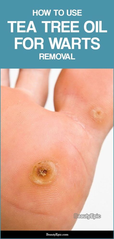 Warts Removal, What Causes Warts, Warts On Hands, Warts On Face, Get Rid Of Warts, Cold Sores Remedies, Natural Sleep Remedies, Natural Cold Remedies, Natural Cough Remedies