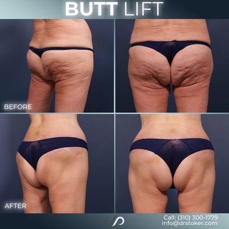 We dramatically improved the appearance of our patient's lower body, highlighting her buttocks. You can see that the wrinkling has greatly diminished, along with her sagging. Her buttocks were lifted and the skin was smoothed out to improve her contour. This is an early post-op that will improve with time and we couldn’t be happier for her. 🍑Improved Body Proportions 🍑Boost In Confidence 🍑Quick Results Droopy Buttocks, Brazilian Buttlift Surgery Results, Body Sculpting Surgery, Body Lift Surgery, Mommy Makeover Surgery, Brazilian Buttlift, Fat Transfer, Mommy Makeover, Body Proportions