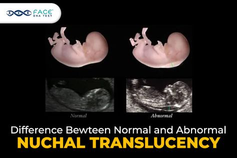 11 Week Ultrasound, Nipt Test, Patau Syndrome, Fetal Ultrasound, Edwards Syndrome, Chromosomal Abnormalities, Genetic Counseling, Ultrasound Technician, Examination Results