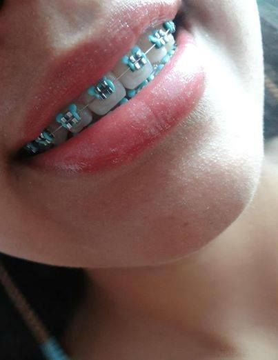 Aqua Braces, Dental Braces Colors, Braces Color Wheel, Jewelry Teeth, Braces Colors Ideas, Lingual Braces, Aqua Outfit, Braces Bands, Teeth Gems