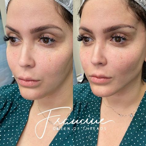 Thread Lift Before And After, Pdo Threads Jawline, Pdo Thread Lift Before And After, Jaw And Cheek Filler, Thread Face Lift Before And After, Face Lift With Threads, Pdo Thread Lift, Mini Face Lift, Thread Lift