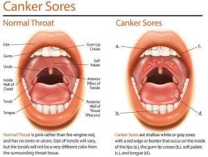 Canker Sore On Tongue, Throat Ulcers, Canker Sore Causes, Blister Remedies, Canker Sore Remedy, Tongue Sores, Fever Blister, Soft Palate, Strep Throat