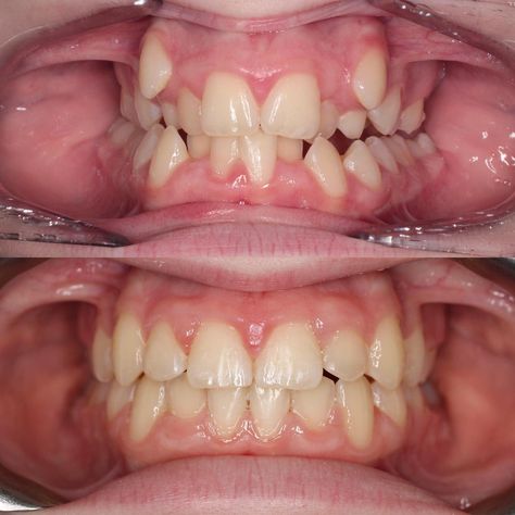 Check out this 15year old female’s transformation! ⠀⠀⠀⠀⠀⠀⠀⠀⠀ Our orthodontics is comprehensive. We don’t just look at aesthetics but functionality too. ⠀⠀⠀⠀⠀⠀⠀⠀⠀ When she came into see Dr.Ng she presented with: -Extremely crowded teeth -Buccally impacted canines -Bilateral crossbite ⠀⠀⠀⠀⠀⠀⠀⠀⠀ After only 15 months of braces she now has: -Improved functionality for chewing -Broader arches -Beautiful straight teeth ⠀⠀⠀⠀⠀⠀⠀⠀⠀ *All accomplished WITHOUT extractions or surgery!* ⠀⠀⠀⠀⠀⠀⠀⠀⠀ If you want t Teeth Implants Before And After, Crowding Teeth, Teeth Reference, Braces Before And After, Orthodontics Teeth, Rotten Teeth, Dental World, Skull Reference, Crooked Teeth