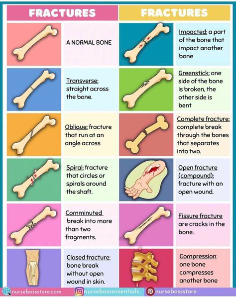 Basic Medical Knowledge, Sports Medicine Physician, Emt Notes, Open Fracture, Nursing School Studying Cheat Sheets, Types Of Fractures, Emt Study, Medical Terminology Study, Medical Tips