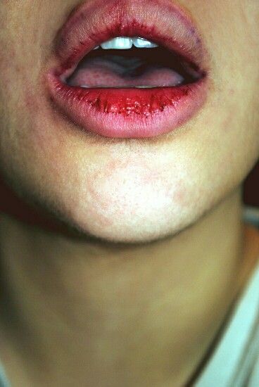 Lips Blood Art, Health Problems, Anatomy, Human Body, Lips, Human, Tumblr, Skin, Makeup