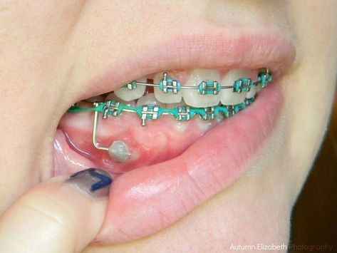 Invisible Teeth Braces, Natural Teeth Whitening Diy, Braces Bands, Cute Braces Colors, Kids Braces, Braces Tips, Getting Braces, Braces Girls, Invisible Braces