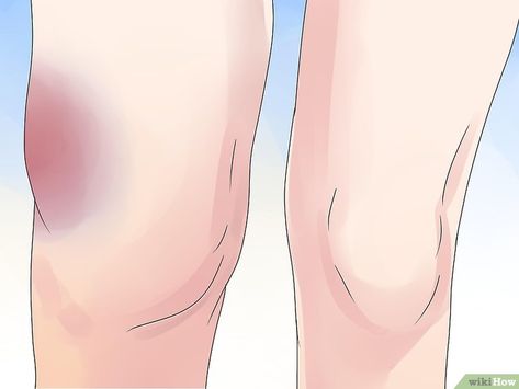 3 Ways to Confirm a Partial ACL Tear - wikiHow Torn Acl Aesthetic, Acl Tear Symptoms, Acl Tear Recovery, Acl Knee, Knee Surgery Recovery, Acl Recovery, Meniscal Tear, Muscle Tear, K Tape