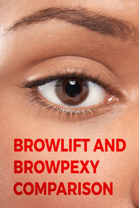 Many people have heard of a brow lift, but not browpexy. Though they sound similar, the two procedures are not the same.  A brow lift is used to reposition the skin and soft tissues of the forehead and brow to diminish forehead wrinkles and sagging of the brow.  Creases and furrows between eyebrows can also be addressed with a brow lift.  Browpexy simply raises the patient’s eyebrows to make them more aesthetically pleasing, but has no effect on the forehead. Brow Lift Before And After, Endoscopic Brow Lift, Brow Lift Surgery, Forehead Lift, Face Surgery, Eyebrow Lift, Wrinkle Remedies, Facial Plastic Surgery, Forehead Wrinkles