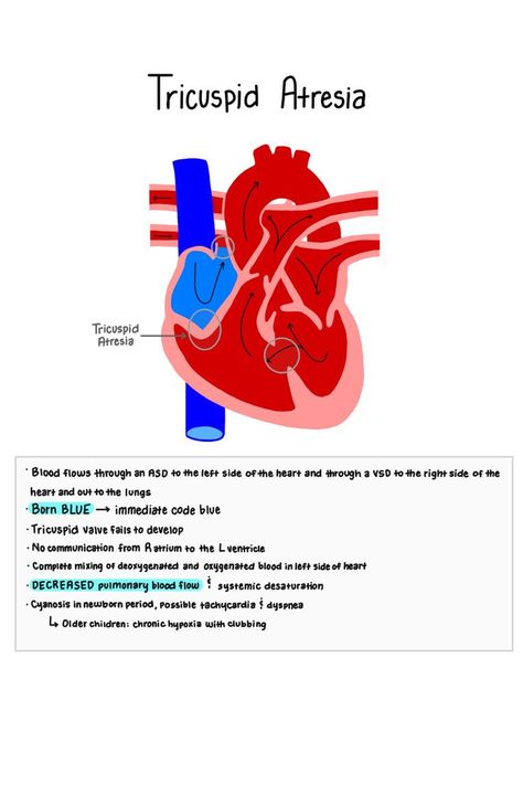 Tricuspid atresia nursing notes. Pediatric congenital heart defect. Tricuspid valve fails to delevop, decreased pulmonary blood flow, complete mixing of deoxygenated and oxygenated blood in left side of heart. Tricuspid Atresia, Cardiac Output Nursing, Pediatric Cardiac Sonography, Pediatric Cardiac Nursing Congenital Heart Defect, Pediatric Cardiology, Cardiac Catherization Nursing, Pulmonary Atresia, Heart Facts, Coronary Arteries Disease Nursing