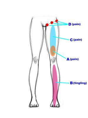 Pain locations: Left Front Thigh Pain can be a diagnostic saga.   Dear webmaster. It is Tim, male, 41 years old from Hong Kong. I've read several of your articles before Thigh Cramps, Leg Muscle Pain, Hip Pain Relief, Pain Relief Remedies, Upper Back Pain, Leg Cramps, Thigh Muscles, Sciatic Nerve Pain, Sciatica Pain